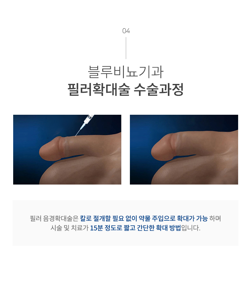 남성수술 이미지12