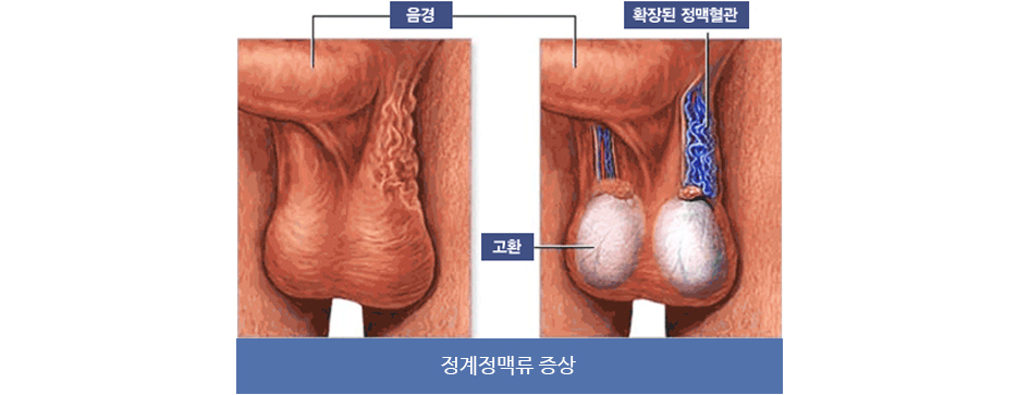 정계정맥류 증상